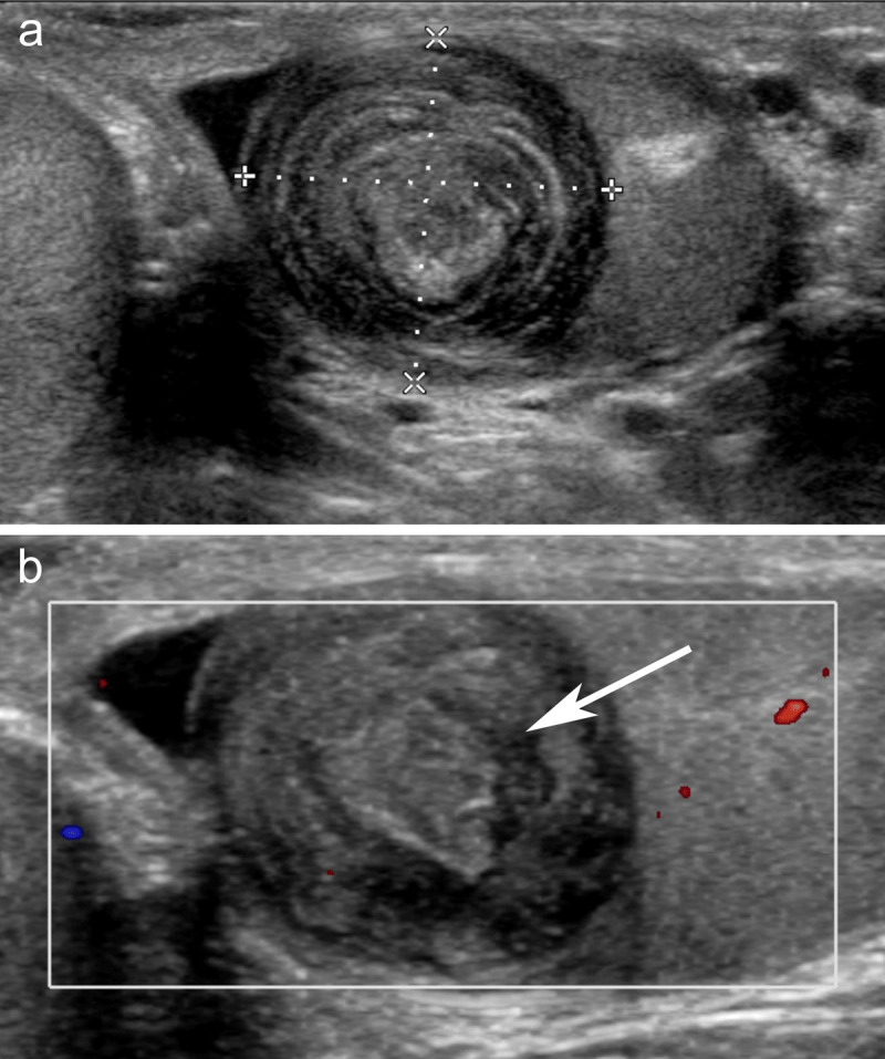 Intrascrotal Testicular and Extratesticular Epidermoid Cysts: About Two Cases.