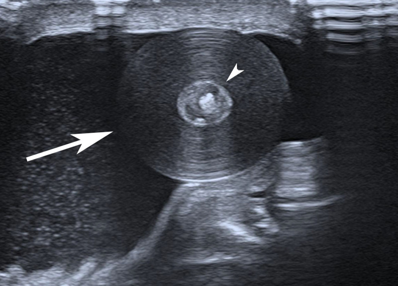 Intrascrotal Testicular and Extratesticular Epidermoid Cysts: About Two Cases.