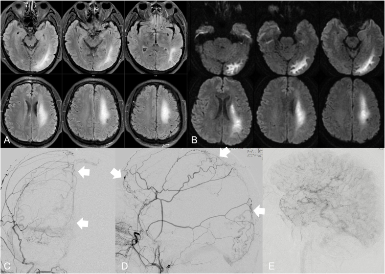 Overview of multimodal MRI of intracranial Dural arteriovenous fistulas