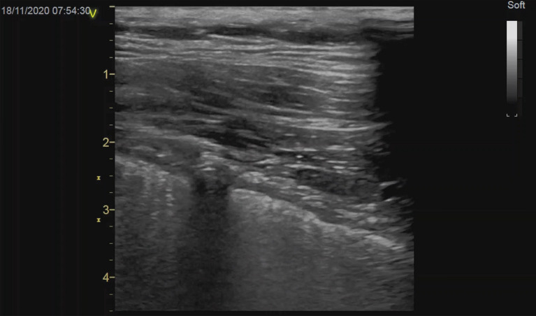 Interpleural location of chest drain on ultrasound excludes pneumothorax and associates with a low degree of chest drain foreshortening on the antero-posterior chest X-ray.