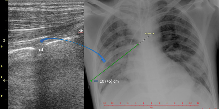 Interpleural location of chest drain on ultrasound excludes pneumothorax and associates with a low degree of chest drain foreshortening on the antero-posterior chest X-ray.