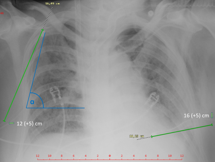 Interpleural location of chest drain on ultrasound excludes pneumothorax and associates with a low degree of chest drain foreshortening on the antero-posterior chest X-ray.