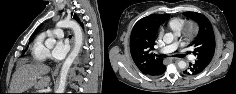 Behçet Disease.