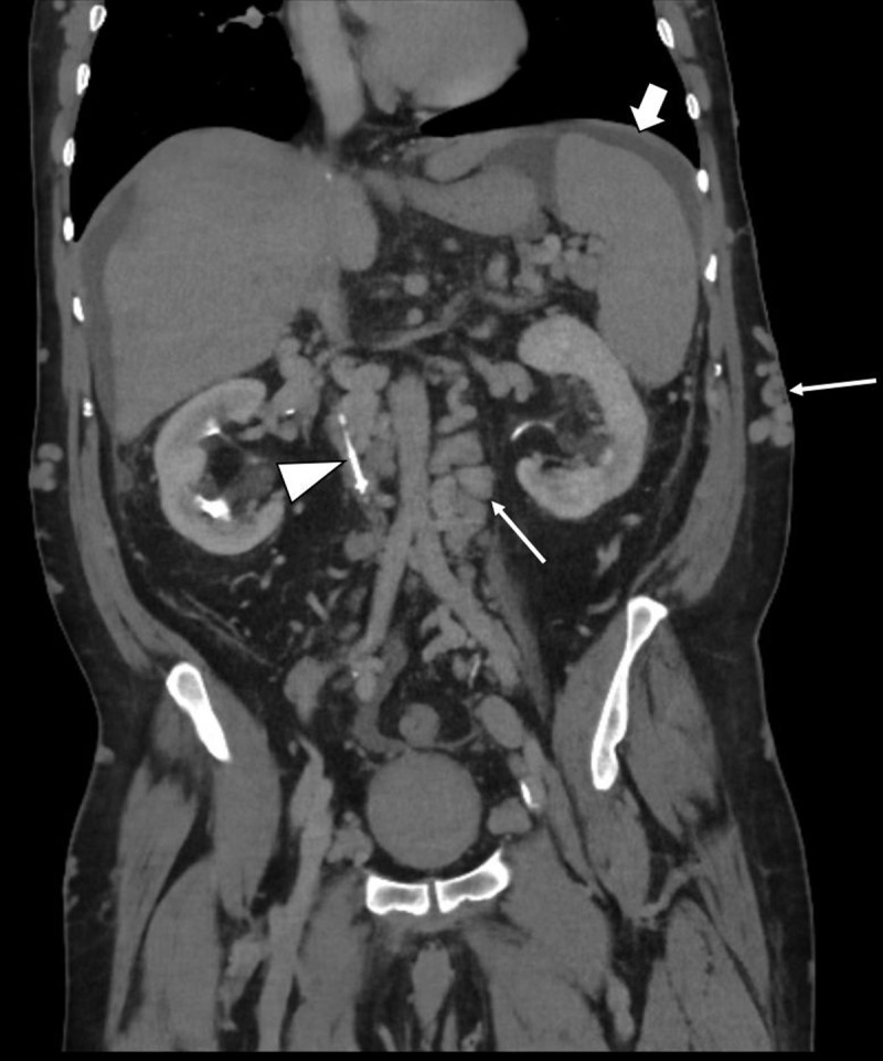 Behçet Disease.