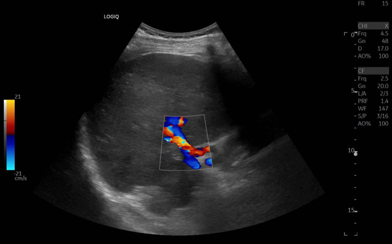 Behçet Disease.