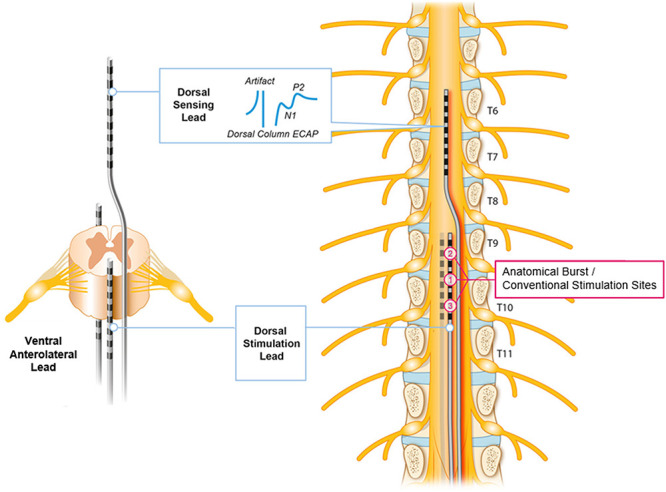 Using evoked compound action potentials to quantify differential neural activation with burst and conventional, 40 Hz spinal cord stimulation in ovines.