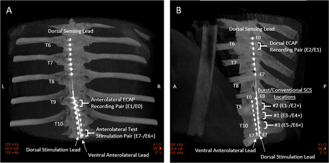 Using evoked compound action potentials to quantify differential neural activation with burst and conventional, 40 Hz spinal cord stimulation in ovines.