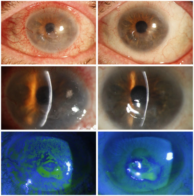 Observational study of cenegermin for the treatment of limbal stem cell deficiency associated with neurotrophic keratopathy.