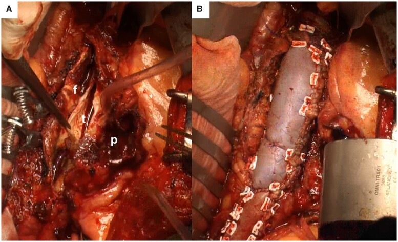 Bovine pericardial patch repair for abdominal aortic pseudoaneurysm to preserve lumbar arteries.