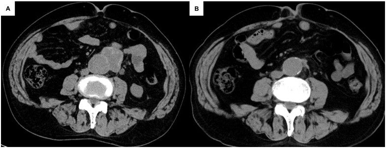 Bovine pericardial patch repair for abdominal aortic pseudoaneurysm to preserve lumbar arteries.