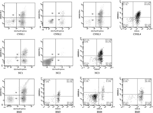 Humanized CD19-directed CAR-T Cell Therapy in Pediatric Relapsed/Refractory Acute Lymphoblastic Leukemia With CNSL or Neurological Comorbidity.