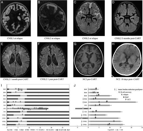 Humanized CD19-directed CAR-T Cell Therapy in Pediatric Relapsed/Refractory Acute Lymphoblastic Leukemia With CNSL or Neurological Comorbidity.