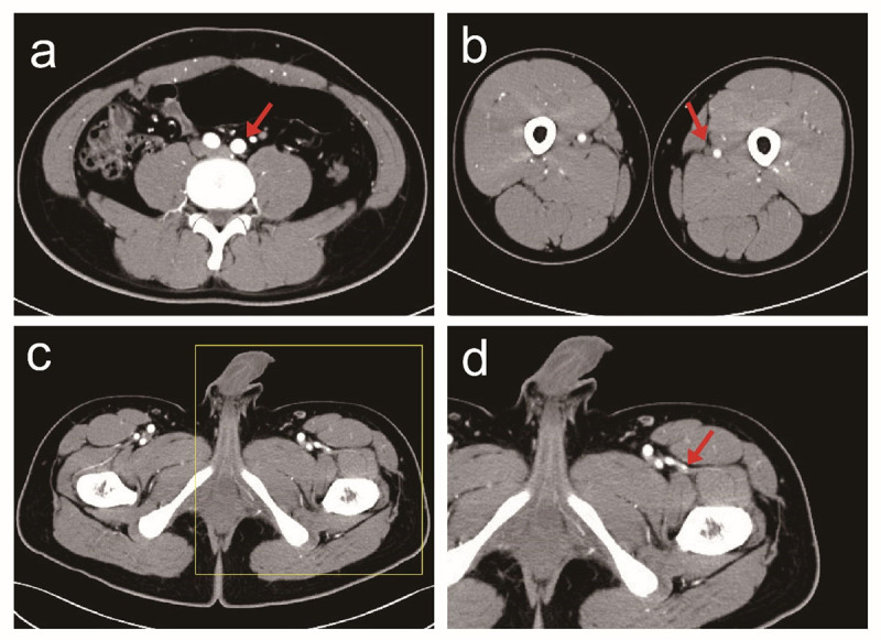 The Correlation Between Body Mass Index and Computed Tomography Angiography on Vascular Positioning in Anterolateral Thigh Flap Transplantation.