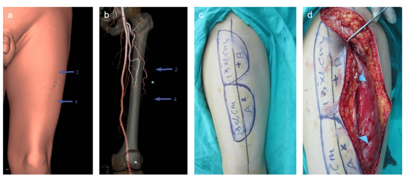 The Correlation Between Body Mass Index and Computed Tomography Angiography on Vascular Positioning in Anterolateral Thigh Flap Transplantation.