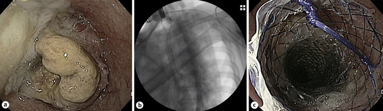 Best Practices in Esophageal, Gastroduodenal, and Colonic Stenting.