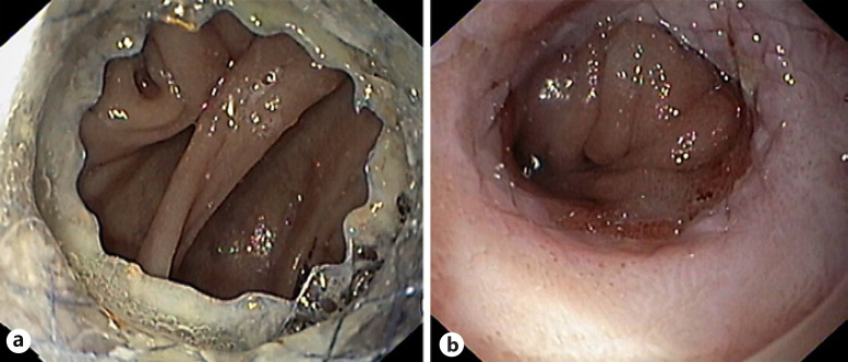 Best Practices in Esophageal, Gastroduodenal, and Colonic Stenting.