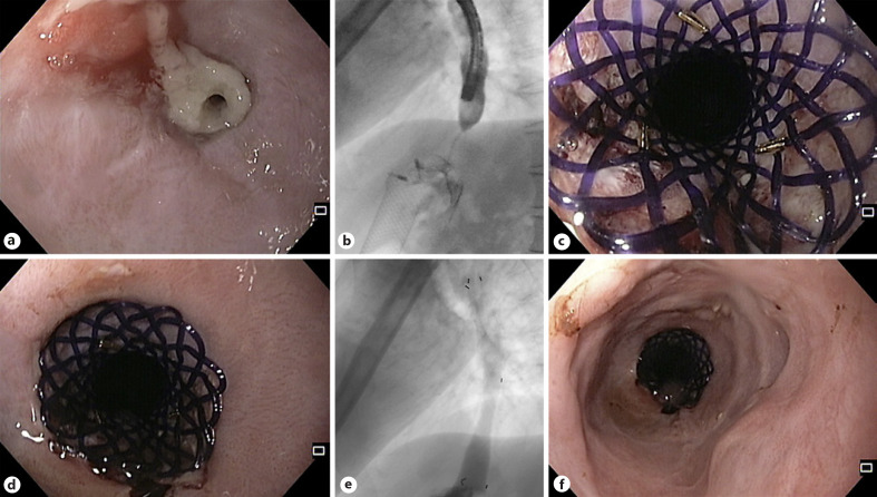 Best Practices in Esophageal, Gastroduodenal, and Colonic Stenting.