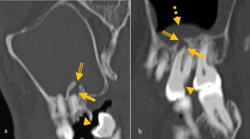 Are We Missing Something in the CT-PNS Report? - an Observational Study on the Rate of Reporting the Presence of Dental Disease and the Probable Etiology of Sinusitis on CT Scans.