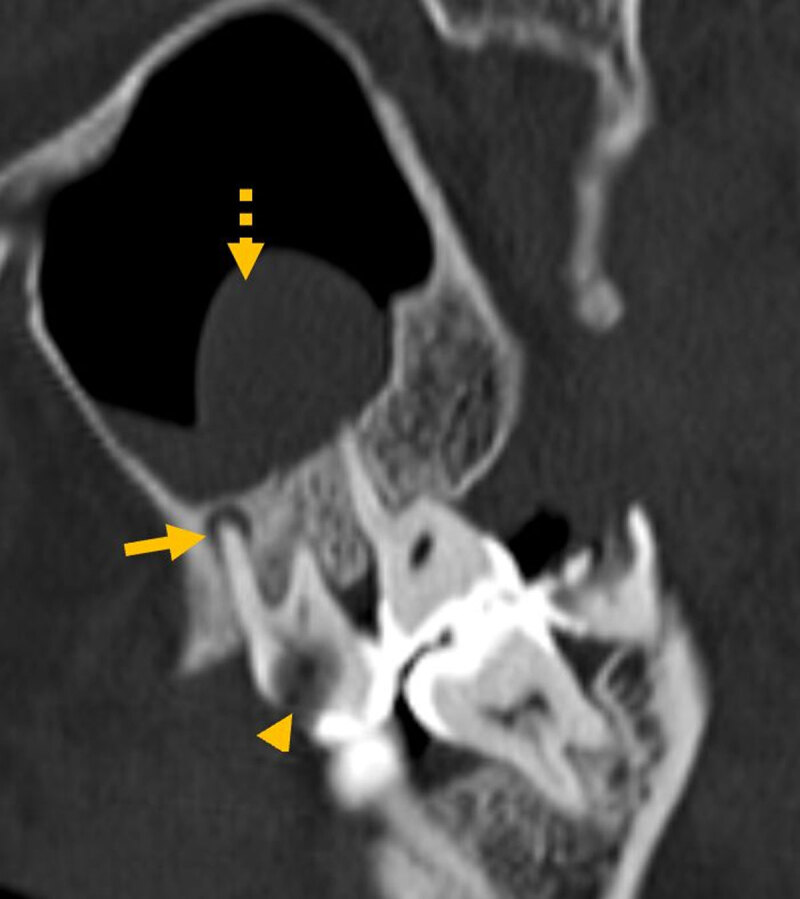 Are We Missing Something in the CT-PNS Report? - an Observational Study on the Rate of Reporting the Presence of Dental Disease and the Probable Etiology of Sinusitis on CT Scans.