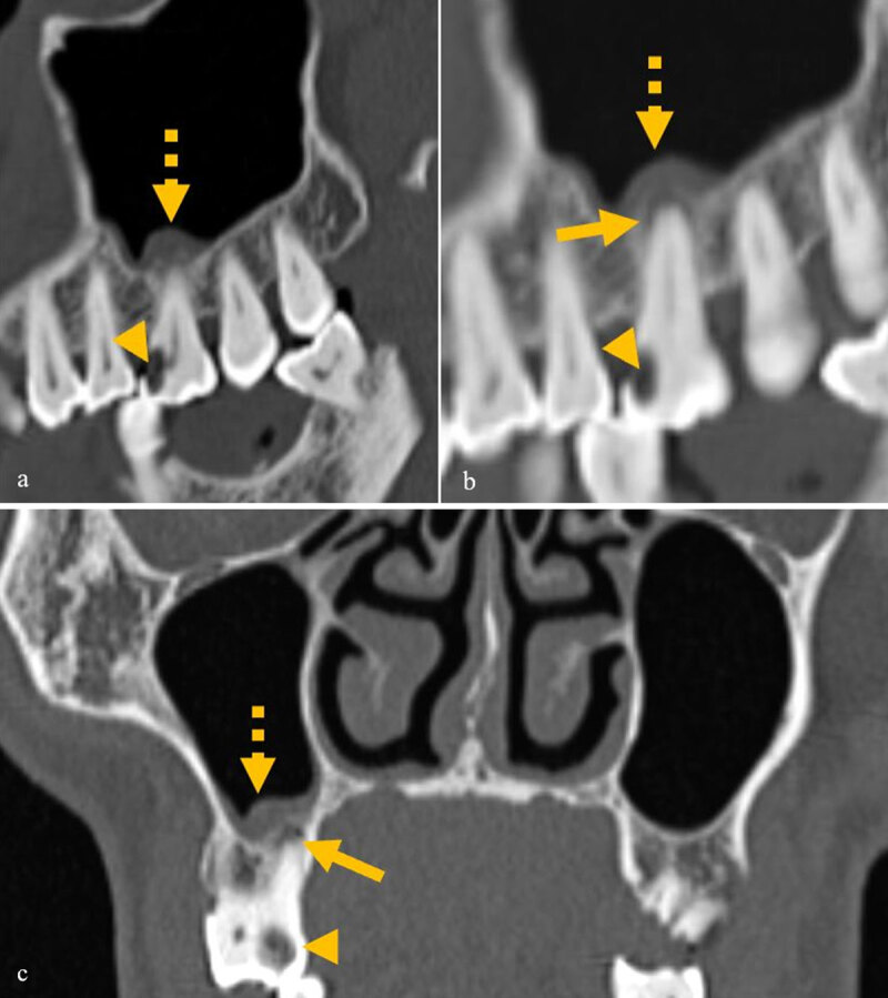 Are We Missing Something in the CT-PNS Report? - an Observational Study on the Rate of Reporting the Presence of Dental Disease and the Probable Etiology of Sinusitis on CT Scans.