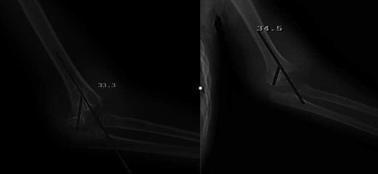 Predictive factors for the development of Gartland type IV supracondylar humerus fractures: a prospective clinical study.