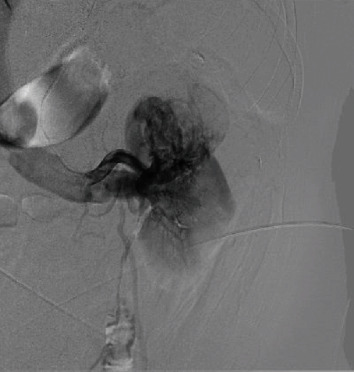 Crisis Averted: Clinical T1b Renal Mass with Concurrent Arteriovenous Malformation and Renal Vein Thrombus.