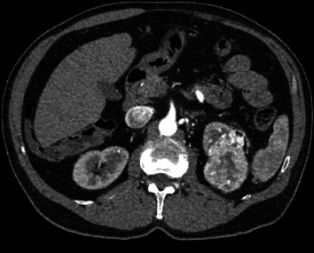 Crisis Averted: Clinical T1b Renal Mass with Concurrent Arteriovenous Malformation and Renal Vein Thrombus.