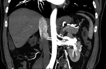 Crisis Averted: Clinical T1b Renal Mass with Concurrent Arteriovenous Malformation and Renal Vein Thrombus.