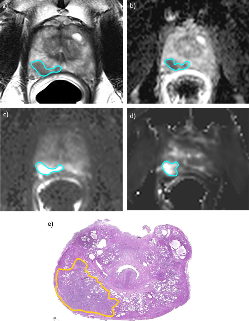 A Comparative Study of Multiparametric MRI Sequences in Measuring Prostate Cancer Index Lesion Volume.