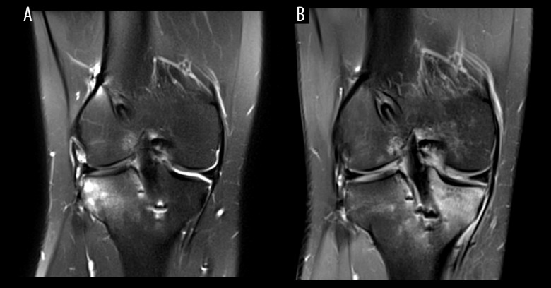 Injury to the Posterior Horn of the Lateral Meniscus from a Misplaced Tibial Tunnel for Anterior Cruciate Ligament Reconstruction: A Case Report.