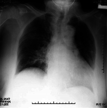 Postoperative Heart Failure with Preserved Ejection Fraction Induced by Flumazenil Administered for Remimazolam Antagonism.