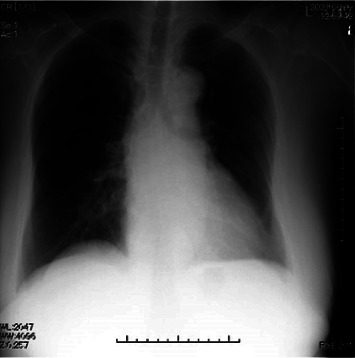 Postoperative Heart Failure with Preserved Ejection Fraction Induced by Flumazenil Administered for Remimazolam Antagonism.