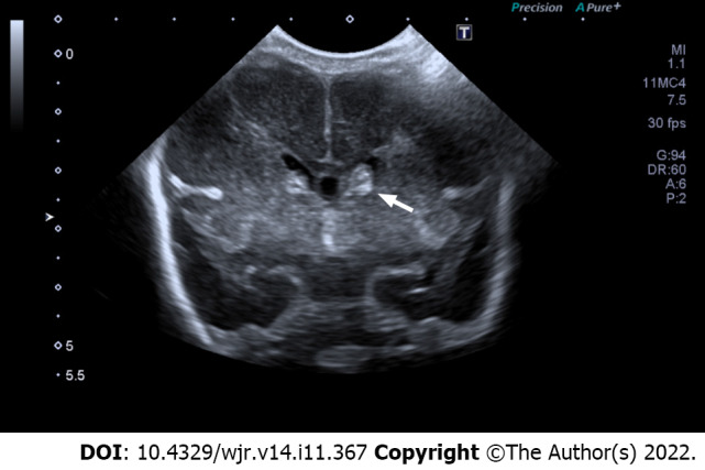 Interobserver reliability between pediatric radiologists and residents in ultrasound evaluation of intraventricular hemorrhage in premature infants.