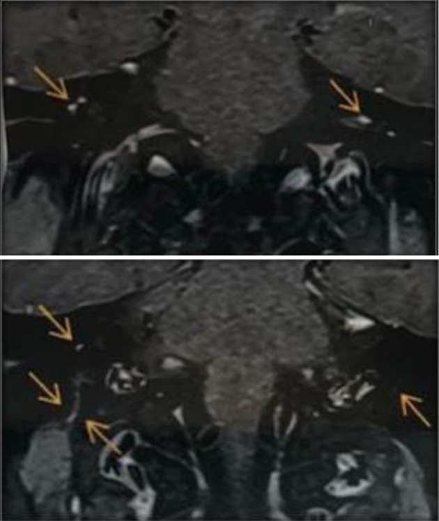 Psychosis and Bilateral Peripheral Facial Palsy Associated With COVID-19.