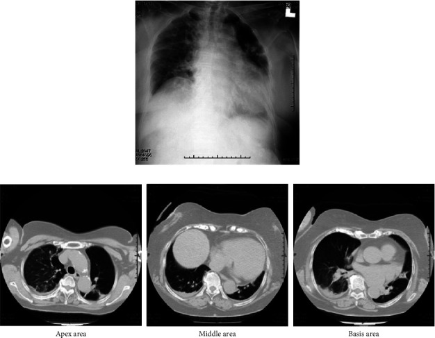 Postoperative Heart Failure with Preserved Ejection Fraction Induced by Flumazenil Administered for Remimazolam Antagonism.