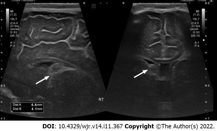 Interobserver reliability between pediatric radiologists and residents in ultrasound evaluation of intraventricular hemorrhage in premature infants.