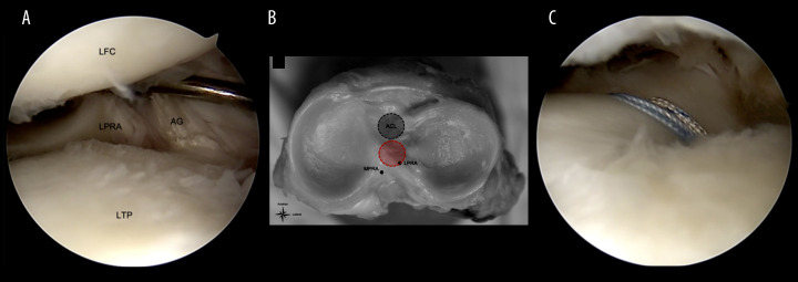 Injury to the Posterior Horn of the Lateral Meniscus from a Misplaced Tibial Tunnel for Anterior Cruciate Ligament Reconstruction: A Case Report.