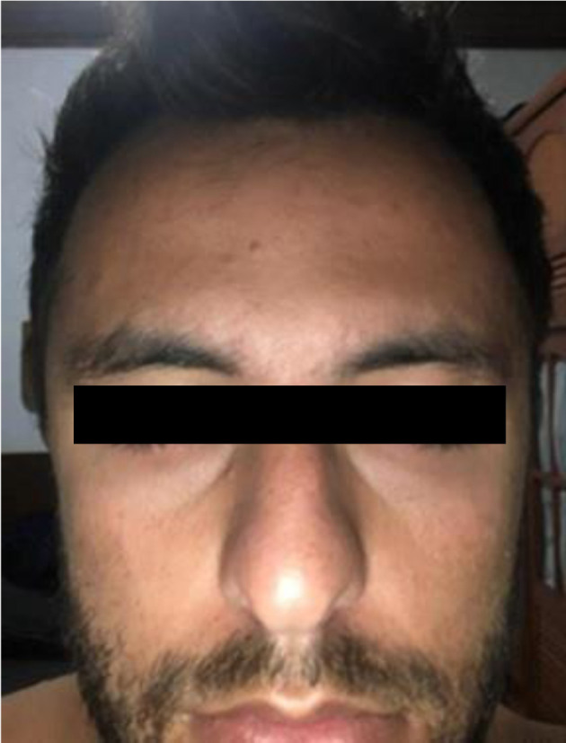 Psychosis and Bilateral Peripheral Facial Palsy Associated With COVID-19.