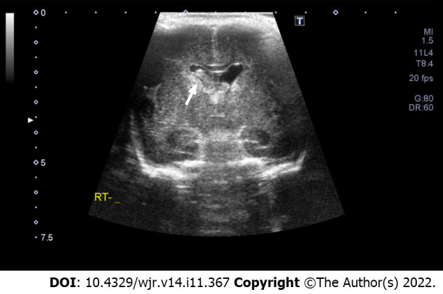 Interobserver reliability between pediatric radiologists and residents in ultrasound evaluation of intraventricular hemorrhage in premature infants.