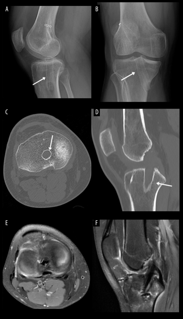 Injury to the Posterior Horn of the Lateral Meniscus from a Misplaced Tibial Tunnel for Anterior Cruciate Ligament Reconstruction: A Case Report.