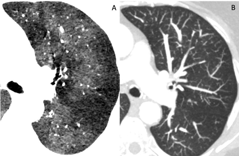 Diffuse Idiopathic Pulmonary Neuroendocrine Cell Hyperplasia (DIPNECH): An Underrecognized Cause of Multiple Lung Nodules and Mosaic Perfusion Pattern.