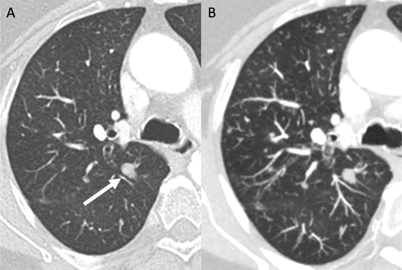 Diffuse Idiopathic Pulmonary Neuroendocrine Cell Hyperplasia (DIPNECH): An Underrecognized Cause of Multiple Lung Nodules and Mosaic Perfusion Pattern.