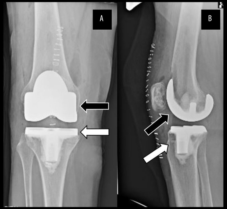 A Rare Case of Prosthetic Joint Infection with Streptococcus gordonii.