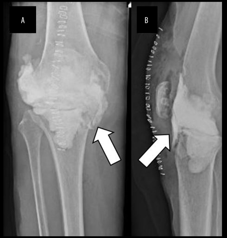 A Rare Case of Prosthetic Joint Infection with Streptococcus gordonii.