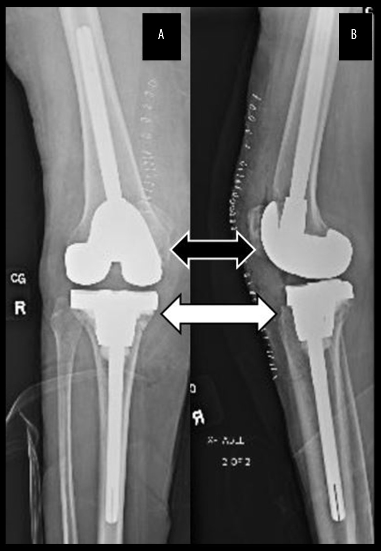 A Rare Case of Prosthetic Joint Infection with Streptococcus gordonii.
