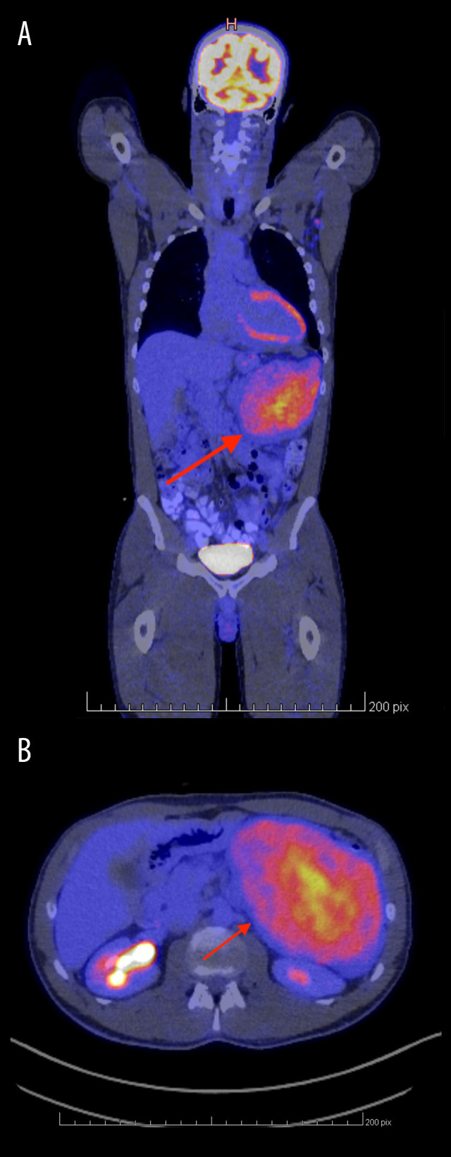 Large Desmoid Tumor of the Pancreas: A Report of a Rare Case and Review of the Literature.