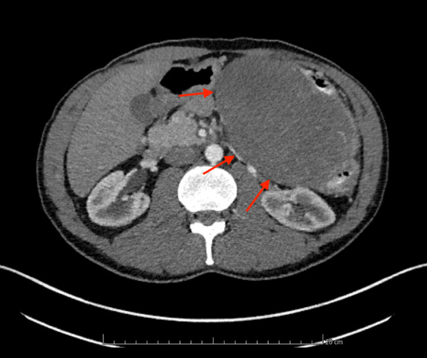 Large Desmoid Tumor of the Pancreas: A Report of a Rare Case and Review of the Literature.
