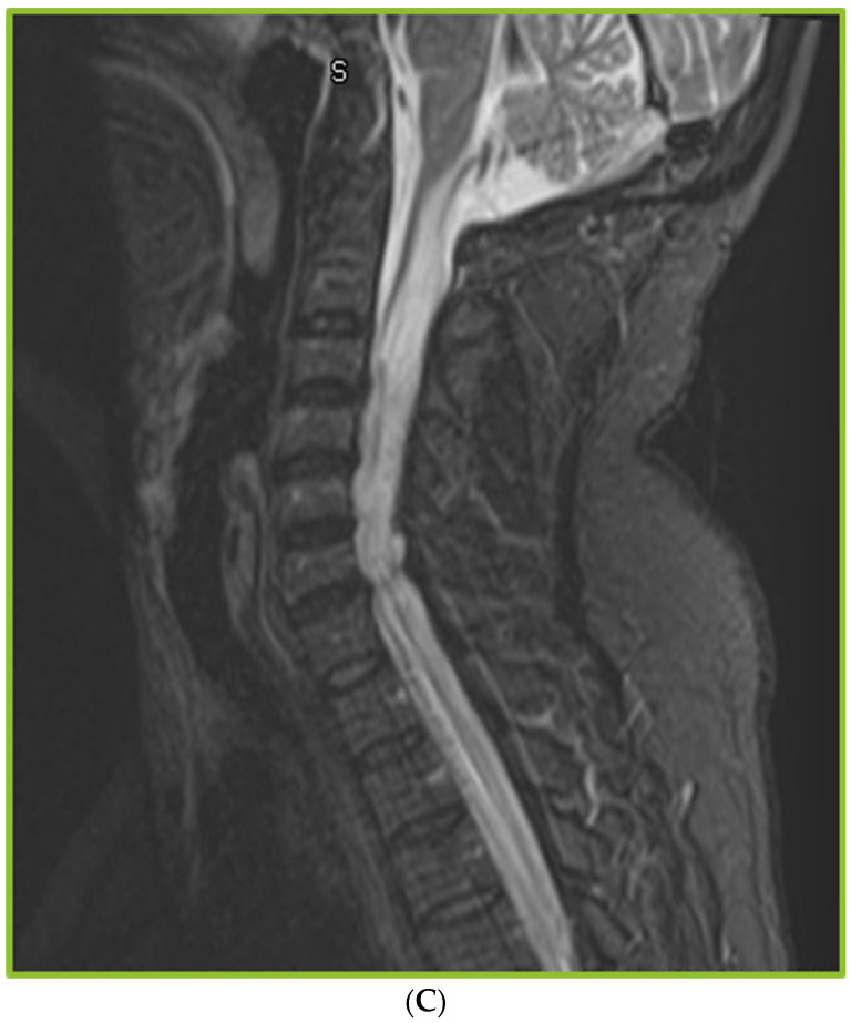 Spinal Arachnoiditis in Patients with Coccidioidomycosis Meningitis-Analysis of Clinical and Imaging Features.