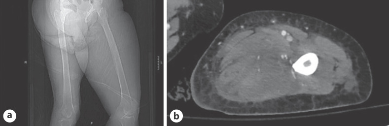 A Case of Acute Myeloid Leukemia-Associated Necrotizing Sweet Syndrome.