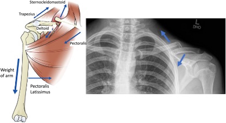 Management of Displaced Midshaft Clavicle Fractures in Pediatrics and Adolescents: Operative vs Nonoperative Treatment.